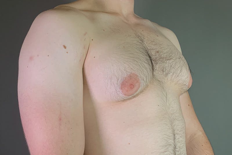 Gynecomastia Before & After Gallery - Patient 337526 - Image 3