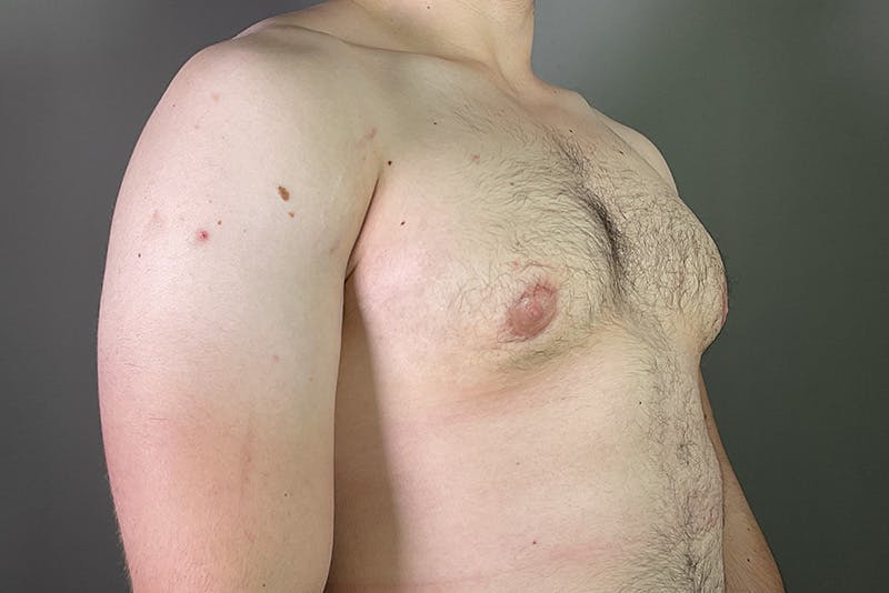 Gynecomastia Before & After Gallery - Patient 337526 - Image 4