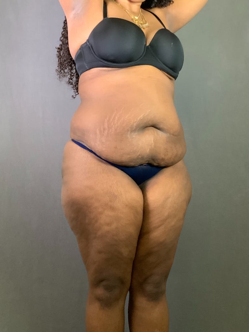 Extended Tummy Tuck  Before & After Gallery - Patient 836512 - Image 3