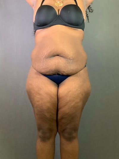 Extended Tummy Tuck  Before & After Gallery - Patient 836512 - Image 1
