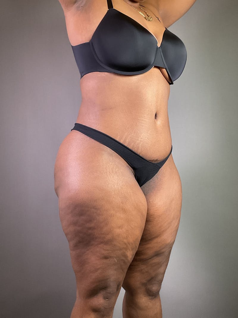 Extended Tummy Tuck  Before & After Gallery - Patient 836512 - Image 4