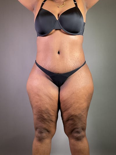 Extended Tummy Tuck  Before & After Gallery - Patient 836512 - Image 2