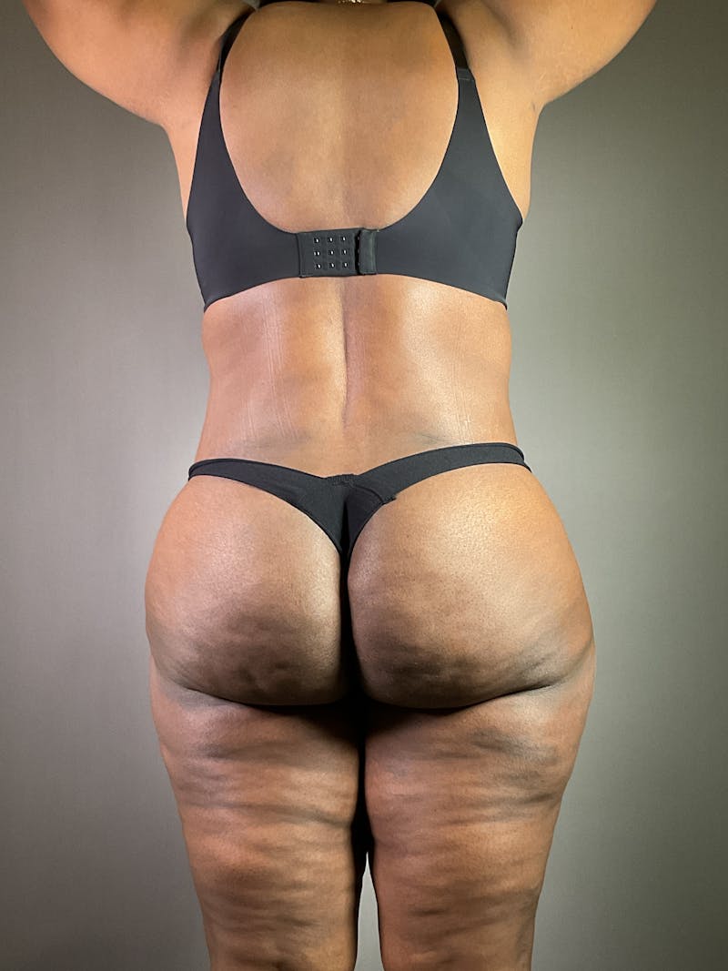 Extended Tummy Tuck  Before & After Gallery - Patient 836512 - Image 6