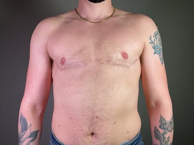 Top Surgery (Female to Male) Before & After Gallery - Patient 146418 - Image 2