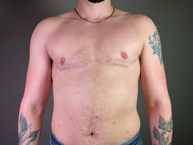 Top Surgery (Female to Male) Before & After Gallery - Patient 146418 - Image 2