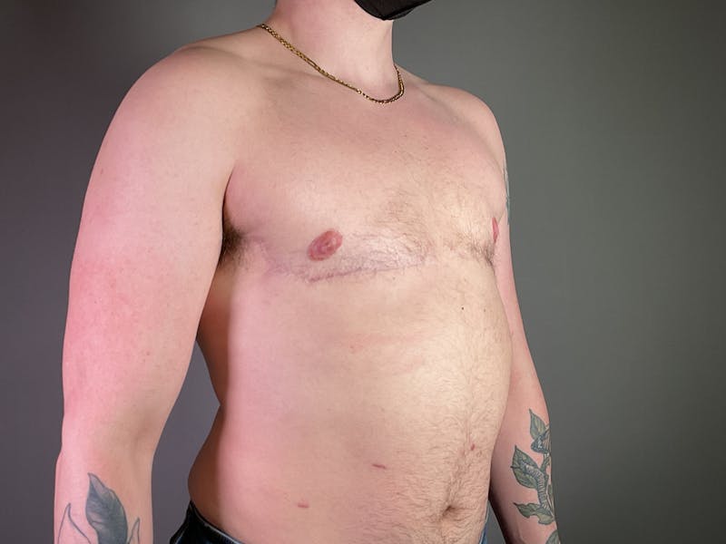 Top Surgery (Female to Male) Before & After Gallery - Patient 146418 - Image 4