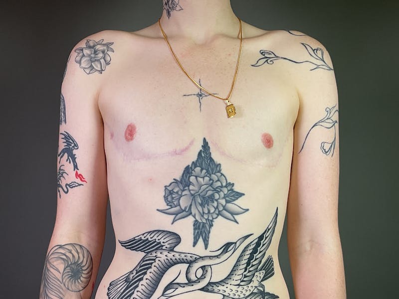 Top Surgery (Female to Male) Before & After Gallery - Patient 317392 - Image 2