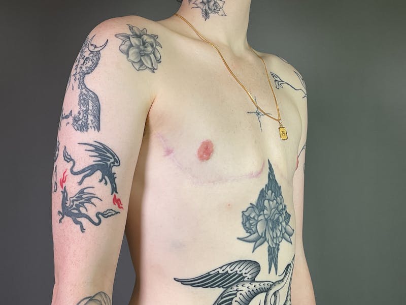 Top Surgery (Female to Male) Before & After Gallery - Patient 317392 - Image 4