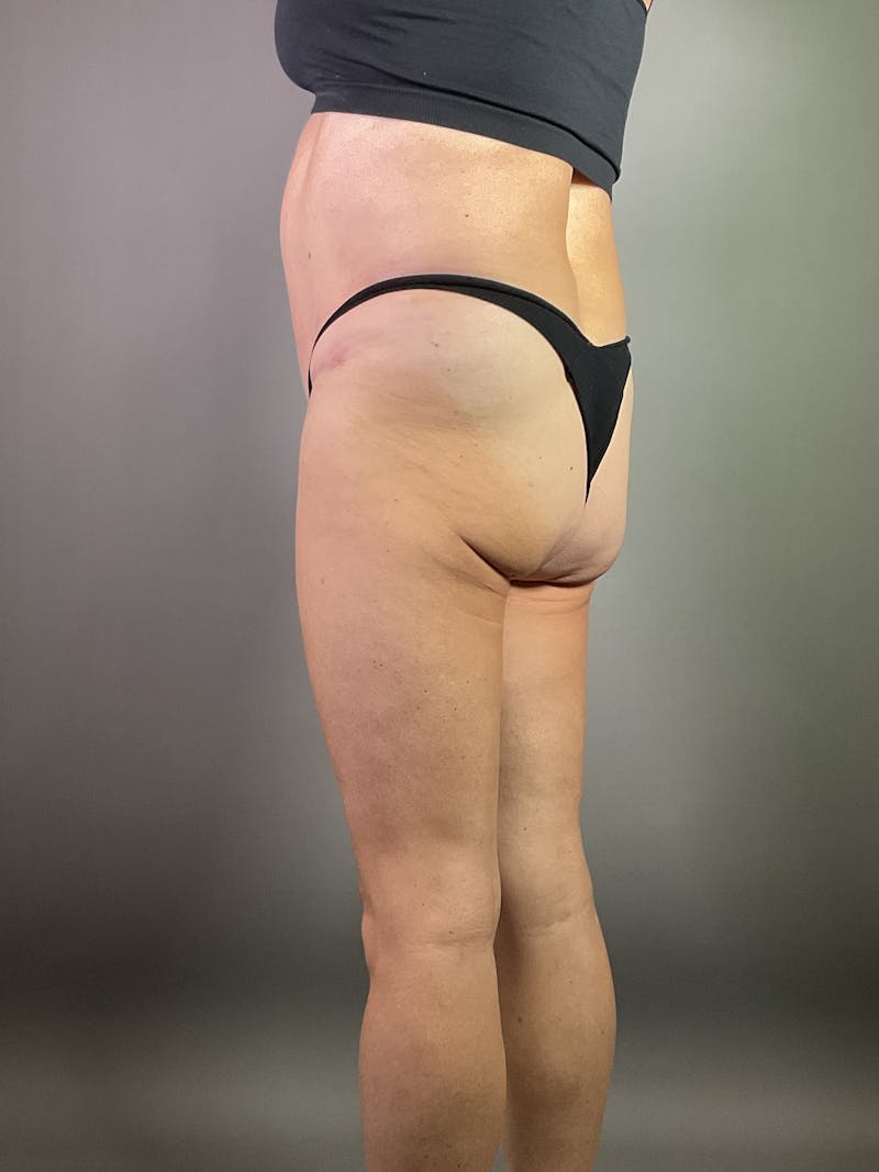 Liposuction Before & After Gallery - Patient 135283 - Image 3