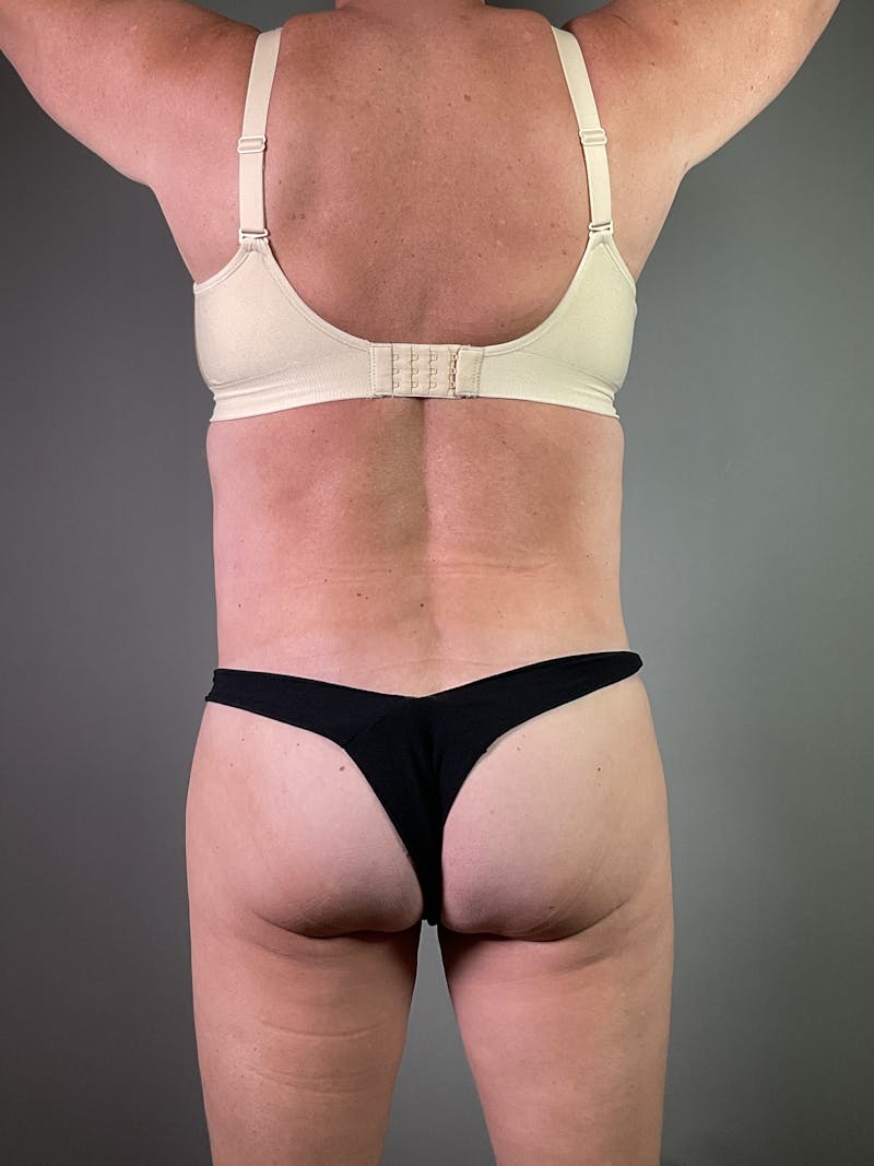 Liposuction Before & After Gallery - Patient 135283 - Image 2