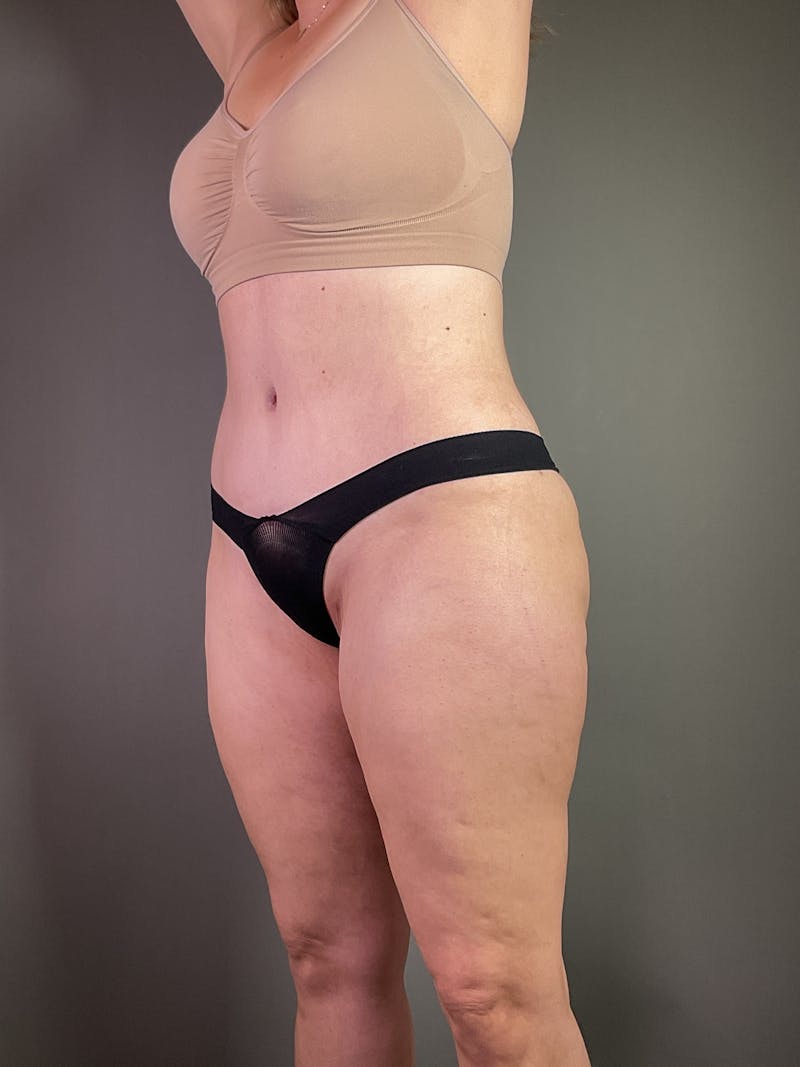 Standard Abdominoplasty Before & After Gallery - Patient 371782 - Image 6