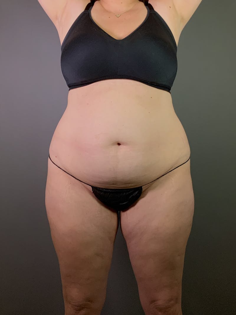 Standard Abdominoplasty Before & After Gallery - Patient 371782 - Image 1