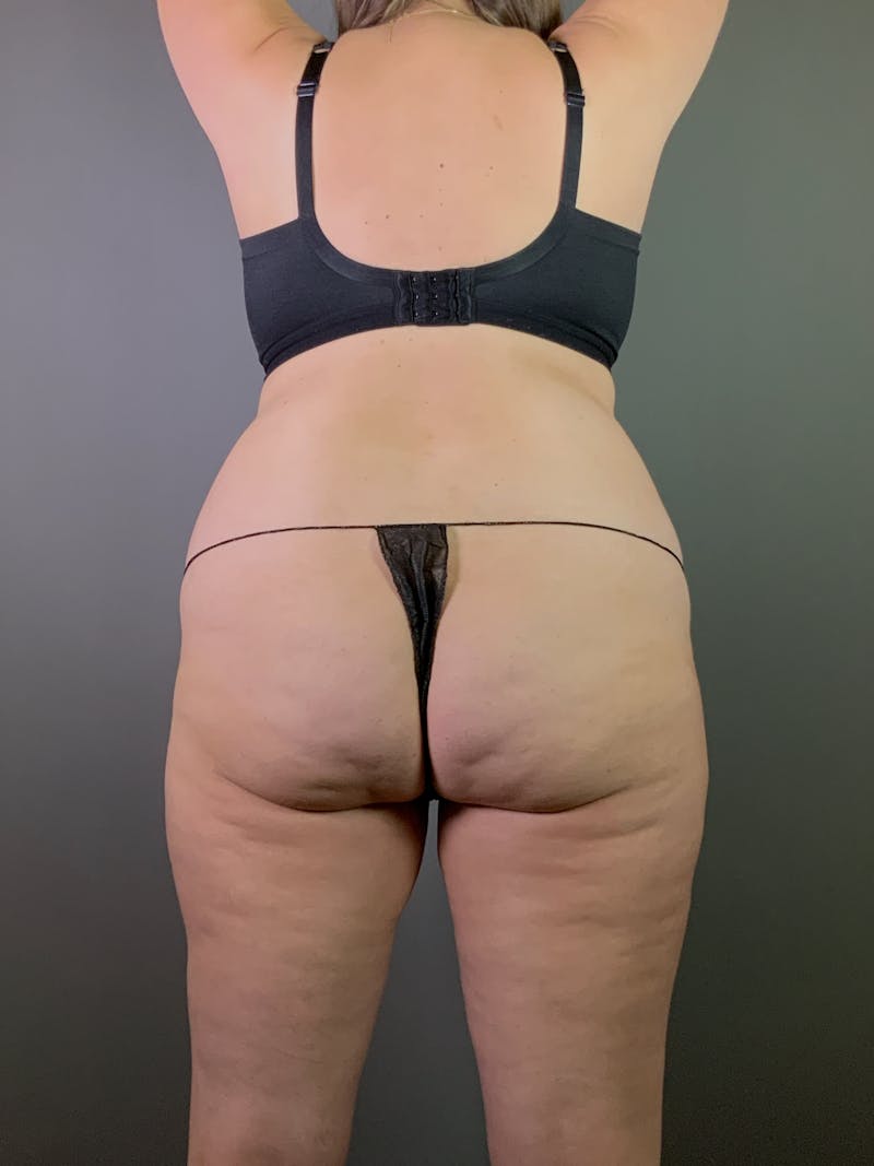 Standard Abdominoplasty Before & After Gallery - Patient 371782 - Image 7