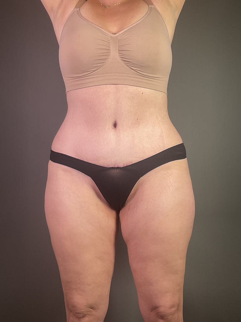 Standard Abdominoplasty Before & After Gallery - Patient 371782 - Image 2