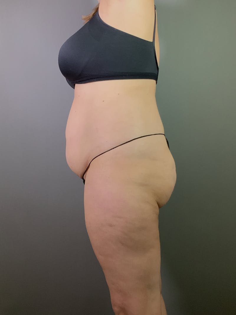 Standard Abdominoplasty Before & After Gallery - Patient 371782 - Image 3