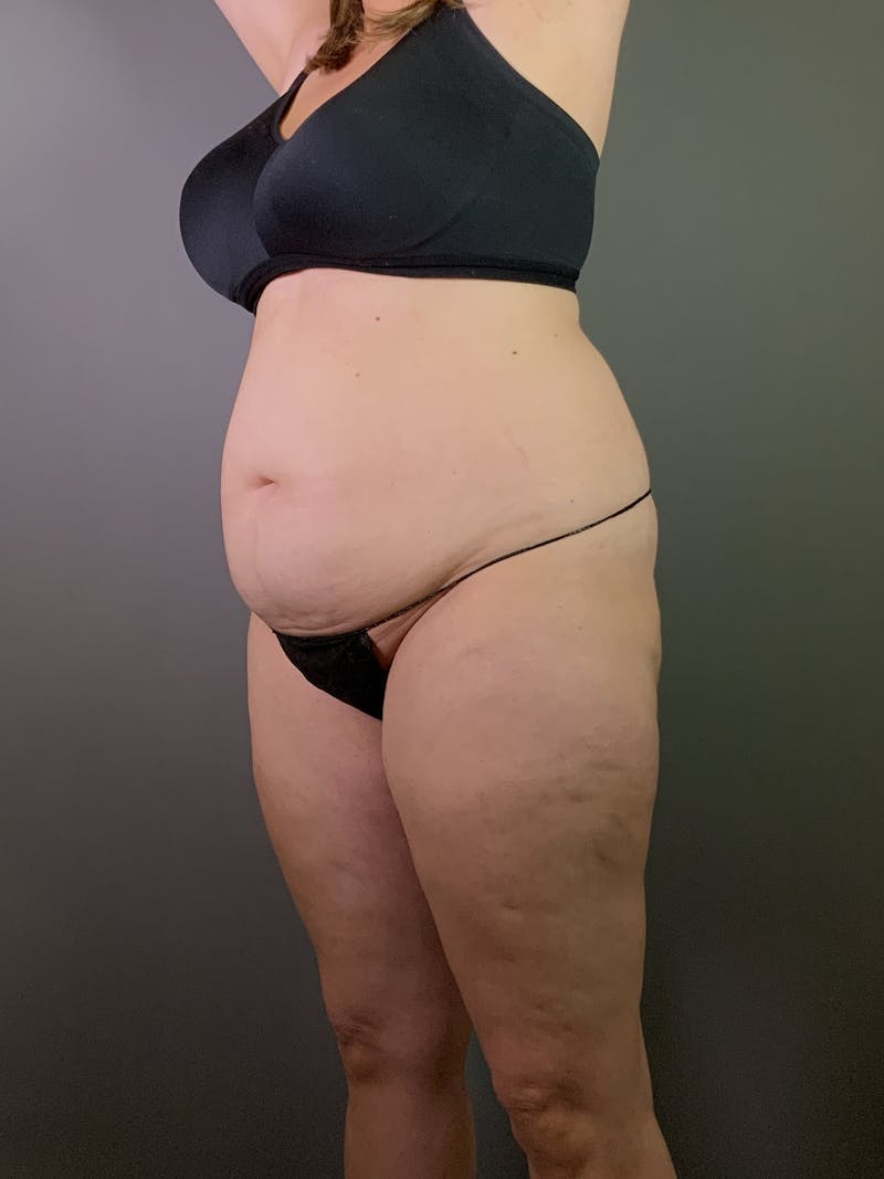 Standard Abdominoplasty Before & After Gallery - Patient 371782 - Image 5