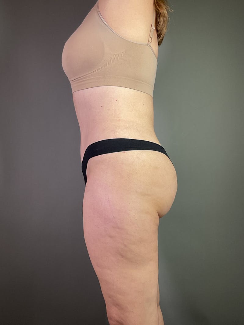 Standard Abdominoplasty Before & After Gallery - Patient 371782 - Image 4