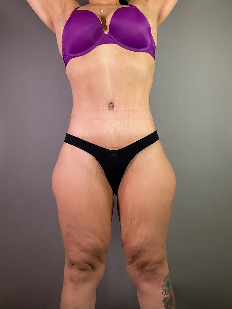 Extended Tummy Tuck  Before & After Gallery - Patient 283883 - Image 2