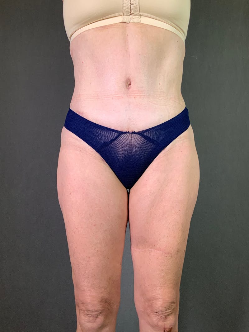Standard Abdominoplasty Before & After Gallery - Patient 372597 - Image 2