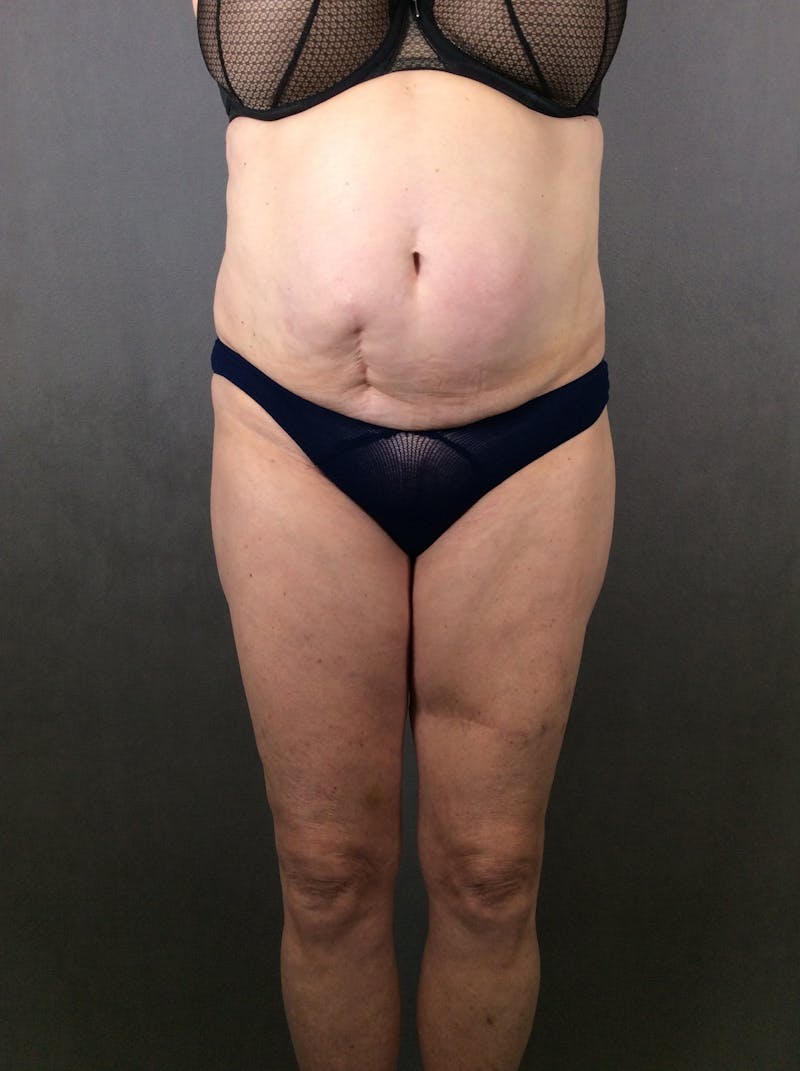 Standard Abdominoplasty Before & After Gallery - Patient 372597 - Image 1