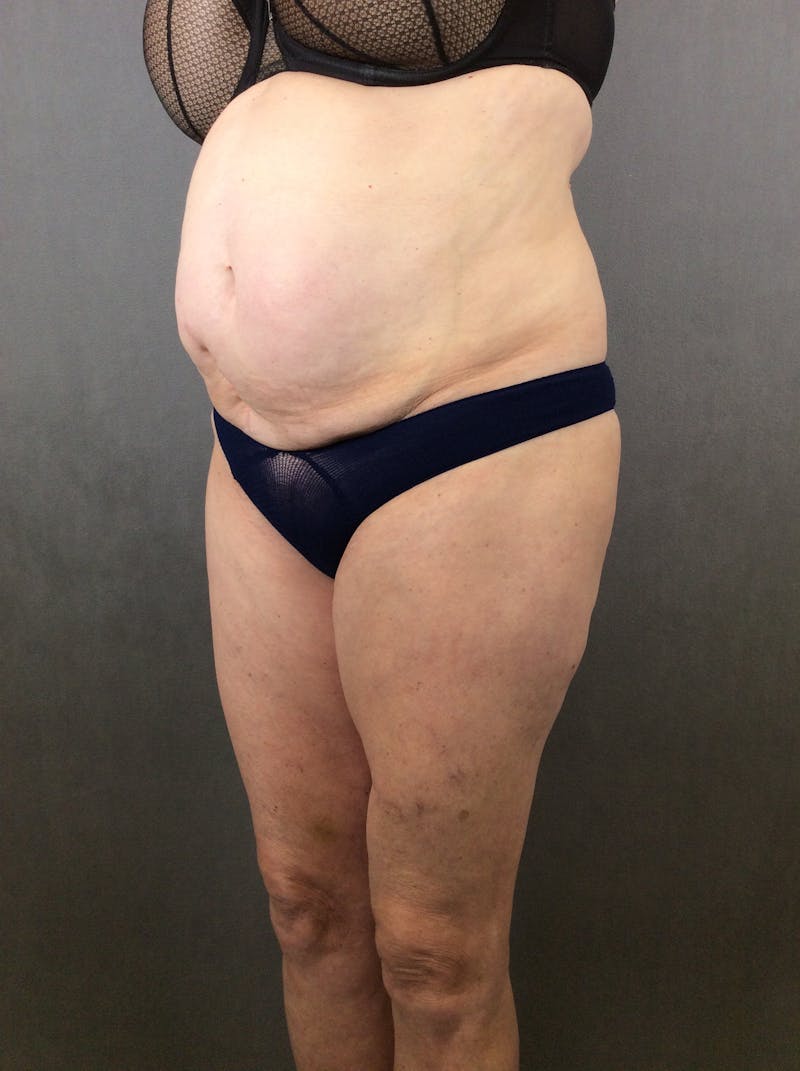 Standard Abdominoplasty Before & After Gallery - Patient 372597 - Image 3
