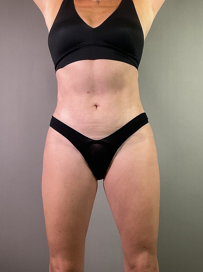Liposuction Before & After Gallery - Patient 100435 - Image 2