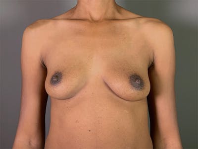 Breast Augmentation Before & After Gallery - Patient 164762 - Image 1