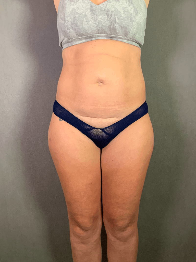High Def Liposuction Renuvion Before & After Gallery - Patient 164234269 - Image 1