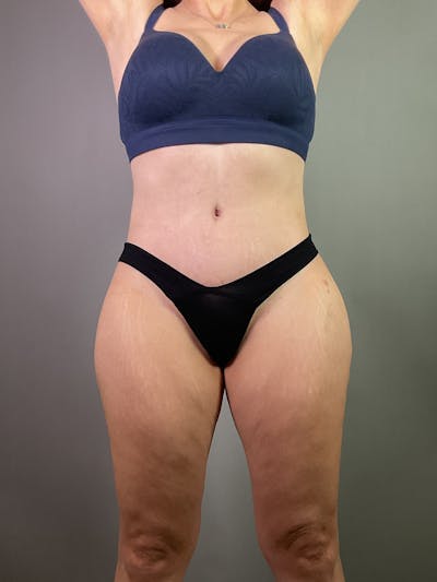 Extended Tummy Tuck  Before & After Gallery - Patient 211411 - Image 2