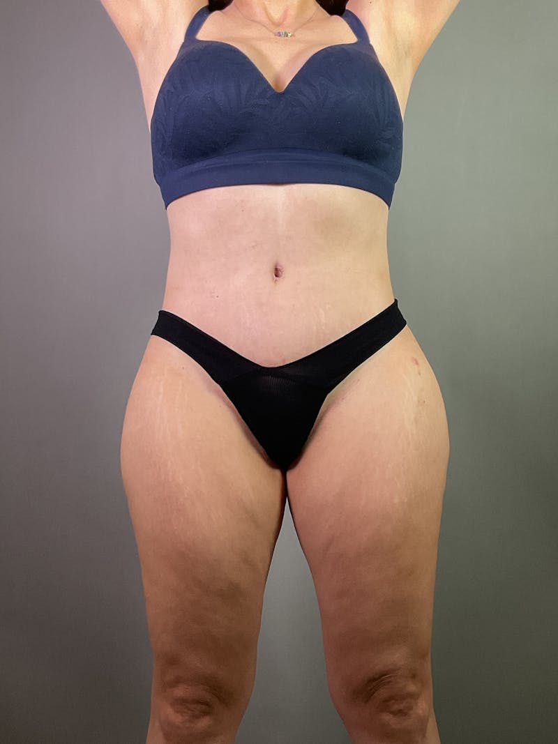 Extended Tummy Tuck  Before & After Gallery - Patient 211411 - Image 2