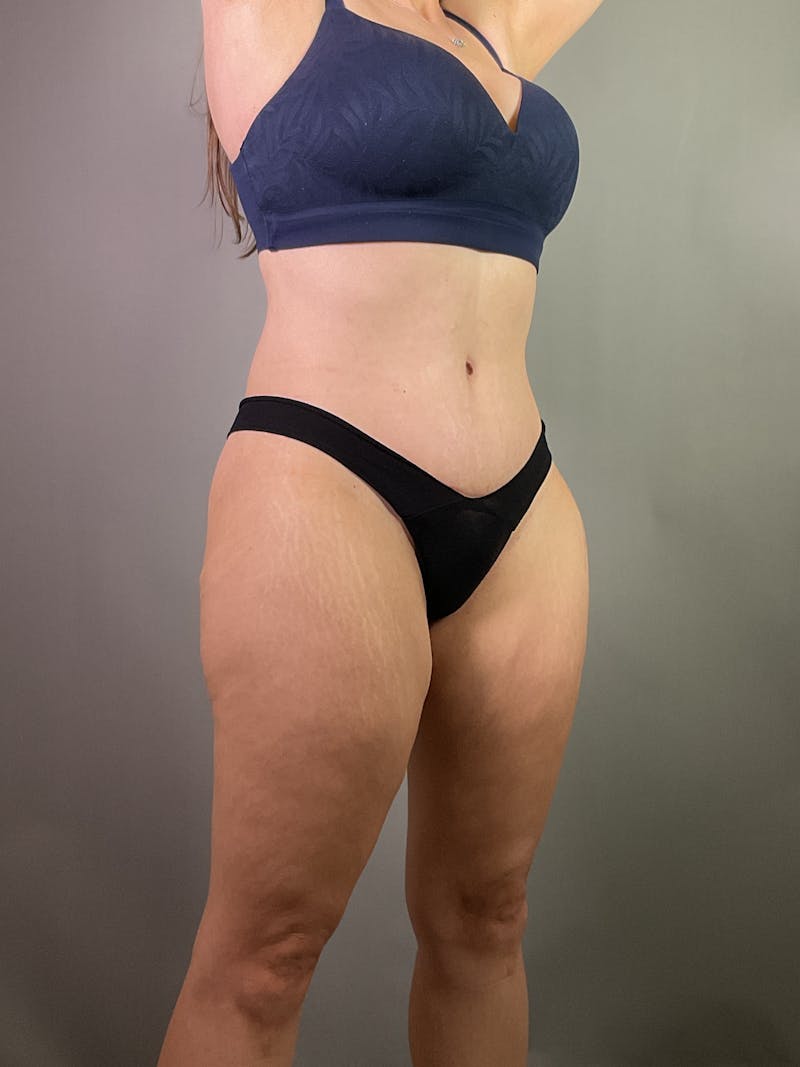 Extended Tummy Tuck  Before & After Gallery - Patient 211411 - Image 4