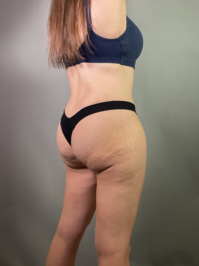 Extended Tummy Tuck  Before & After Gallery - Patient 211411 - Image 5