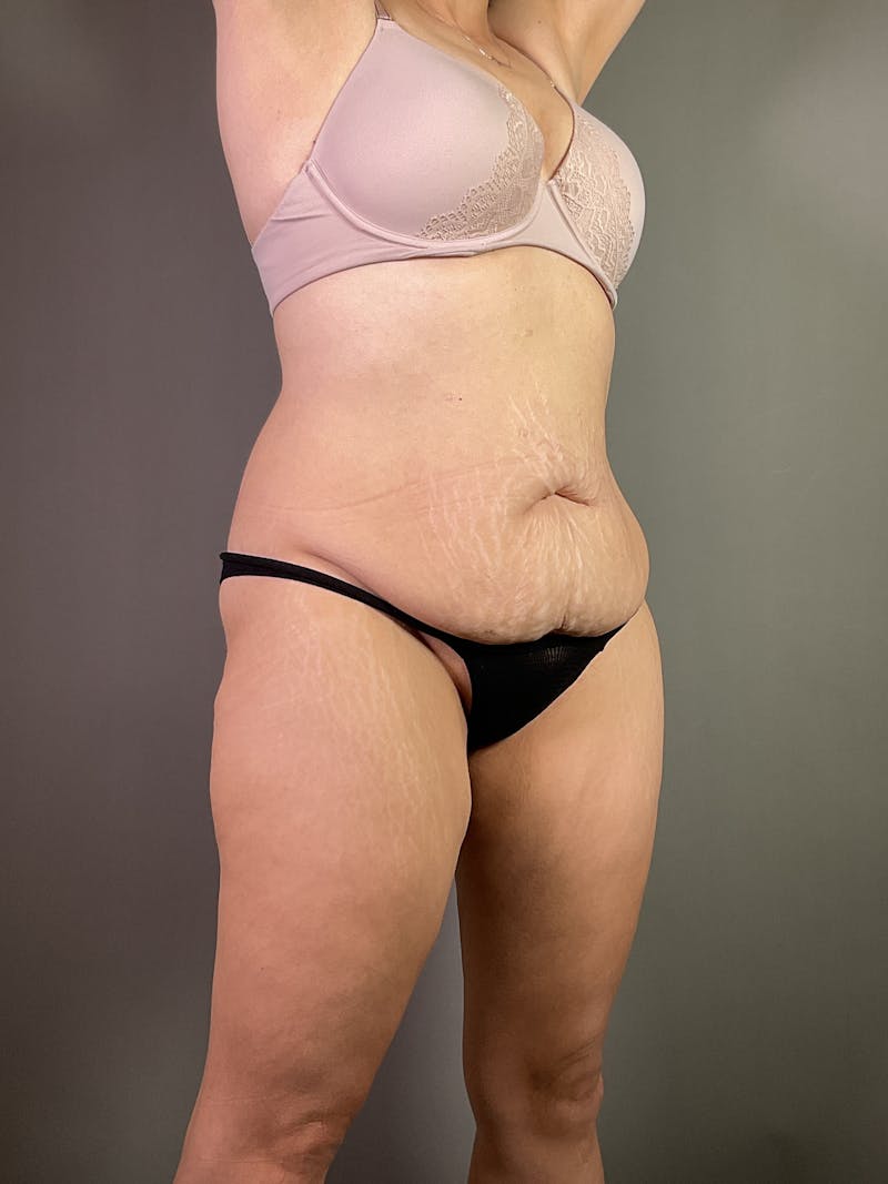 Extended Tummy Tuck  Before & After Gallery - Patient 211411 - Image 3