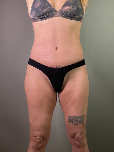 Extended Tummy Tuck  Before & After Gallery - Patient 305648 - Image 2