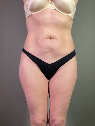 Standard Abdominoplasty Before & After Gallery - Patient 123684 - Image 1