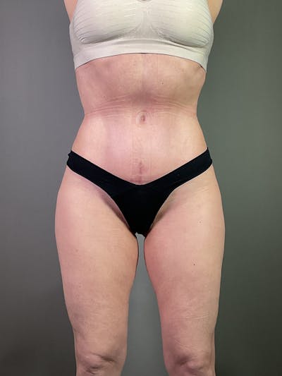 Standard Abdominoplasty Before & After Gallery - Patient 123684 - Image 2