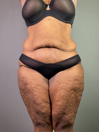 Extended Tummy Tuck  Before & After Gallery - Patient 120043 - Image 1