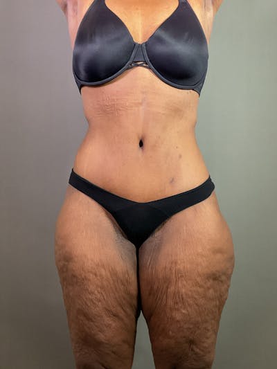 Extended Tummy Tuck  Before & After Gallery - Patient 120043 - Image 2