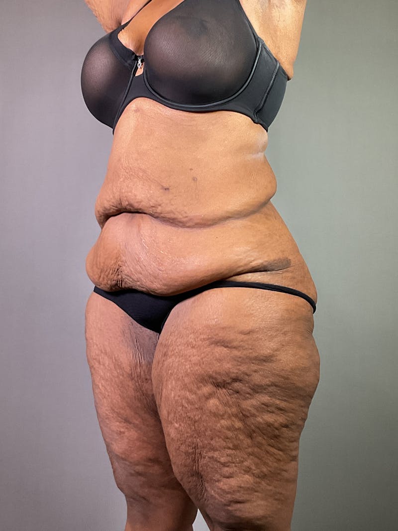 Extended Tummy Tuck  Before & After Gallery - Patient 120043 - Image 3