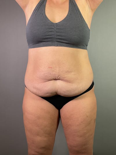Extended Tummy Tuck  Before & After Gallery - Patient 924737 - Image 1