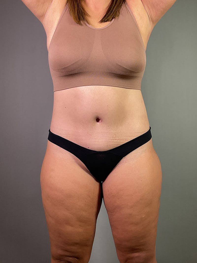 Extended Tummy Tuck  Before & After Gallery - Patient 924737 - Image 2