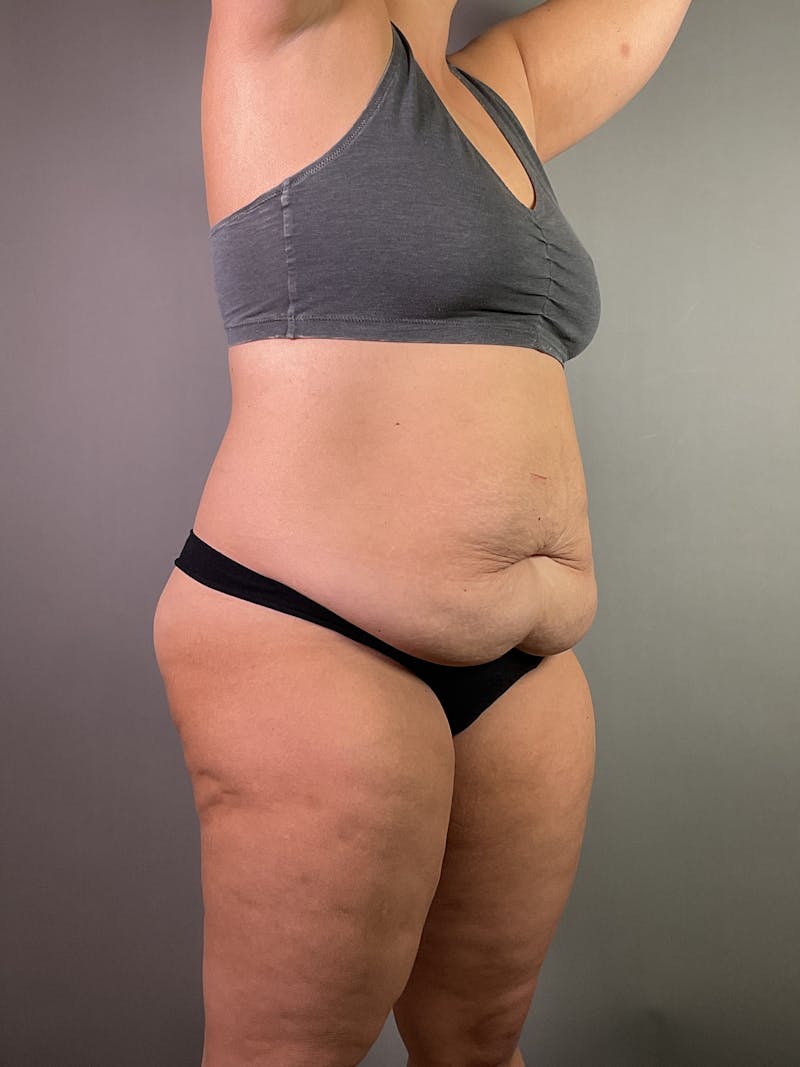 Extended Tummy Tuck  Before & After Gallery - Patient 924737 - Image 3