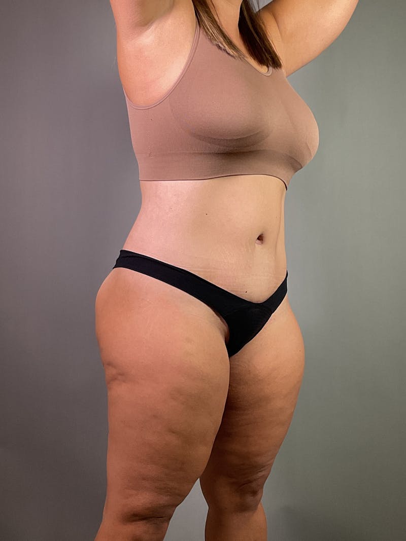 Extended Tummy Tuck  Before & After Gallery - Patient 924737 - Image 4