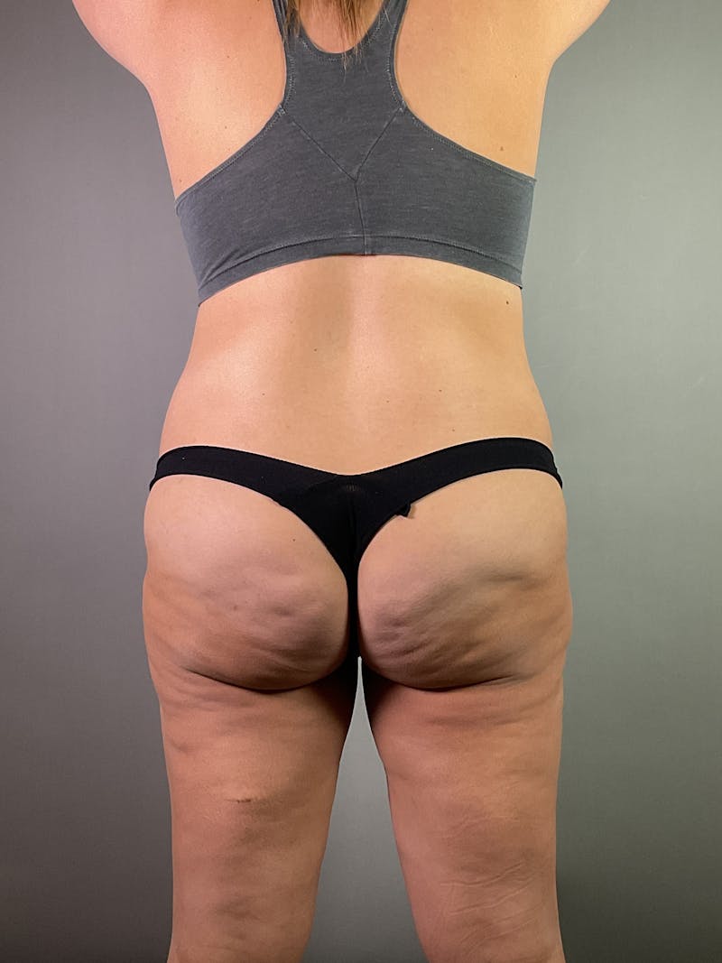 Extended Tummy Tuck  Before & After Gallery - Patient 924737 - Image 5