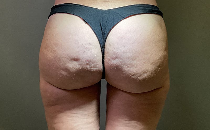 Aveli Cellulite Before & After Gallery - Patient 285018 - Image 1