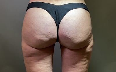 Aveli Cellulite Before & After Gallery - Patient 285018 - Image 2