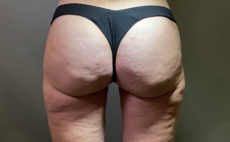 Aveli Cellulite Before & After Gallery - Patient 285018 - Image 2