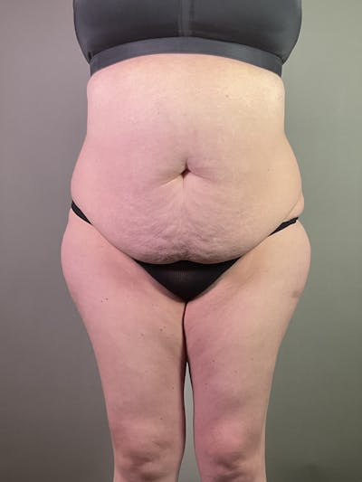 Standard Abdominoplasty Before & After Gallery - Patient 358069 - Image 1