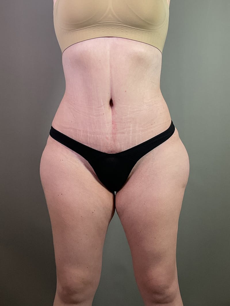 Standard Abdominoplasty Before & After Gallery - Patient 358069 - Image 2