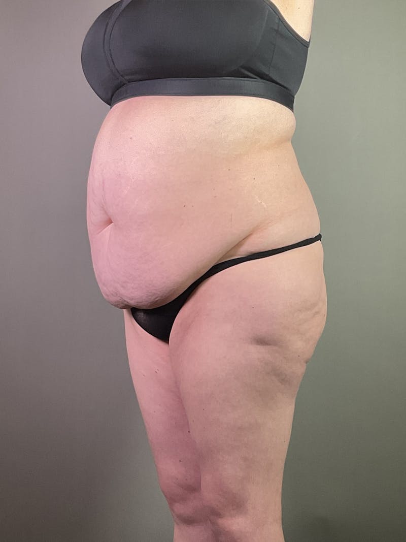 Standard Abdominoplasty Before & After Gallery - Patient 358069 - Image 3